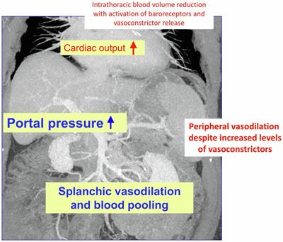 Bile Acids, Liver Cirrhosis, and Extrahepatic Vascular Dysfunction